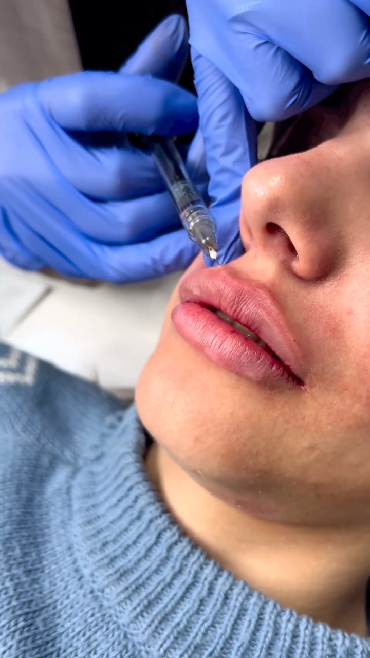 Aplicación de ácido hialurónico en el labio superior, con guantes y jeringa